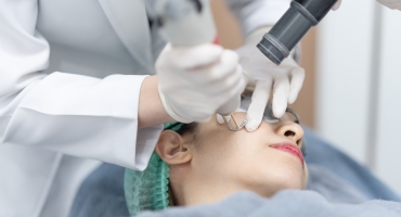 Laser Pigmentation Removal